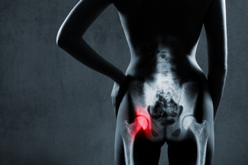 Human hip joint in x-ray on gray background. Painful hip joint is highlighted by red color. X-ray...