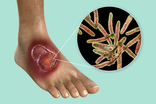 Buruli Ulcer On A Patient Foot, 3D Illustration. The Disease Caused By Mycobacterium Ulcerans Bacteria