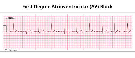 ECG First Degree Atrioventricular Block - 1st degree AV Block - 8 Second ECG Paper - Electrocardiography Vector Medical Illustration