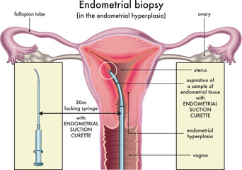 Medical illustration  of the endometrial biopsy procedure in the endometrial hyperplasia with annotations.