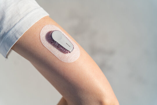 MINSK, BELARUS - FEBRUARY, 2023: Continuous Glucose Monitoring Dexcom on a hand close up. Track glucose levels