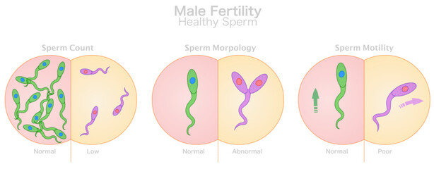 Male fertility, sperm healthy. Count, morphology, motility. Compare, normal, low, abnormal, poor. Collecting semen, movement shape. Microscopic cells. Test tube baby, IVF. Illustration vector