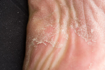Foot skin Cracked up dead skin peel desquamation medical condition flaking