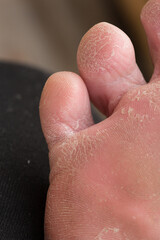 Foot skin Cracked up dead skin peel desquamation medical condition flaking