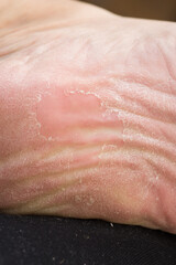 Foot skin Cracked up dead skin peel desquamation medical condition flaking