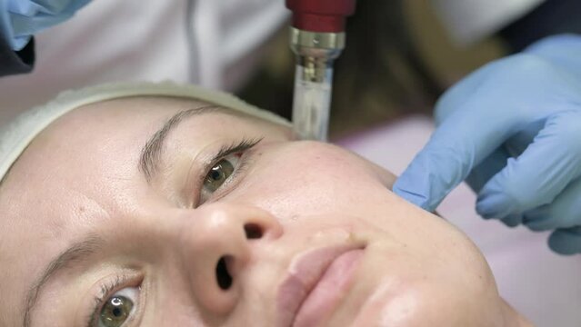 Mesotherapy for the skin of the face with the help of a dermapen, a visit to a cosmetologist.