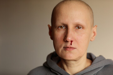 Obraz premium Young bald cancer sick woman is bleeding from her nose, effects of chemotherapy. Female lost her eyebrows and eyelashes and has heavy nosebleed with red blood on the face. Healthcare concept