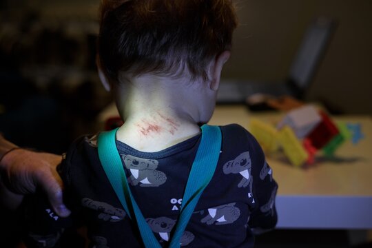 The picture showing the scratched neck of a child after an allergy can also be used as an illustrative cartoon about abused children