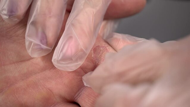 A doctor examines a callus on a man's hand. Fungal skin disease. Close-up hands.