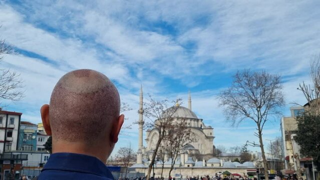 man with recent hair transplant admires the blue mosque which is located in istanbul, turkey.