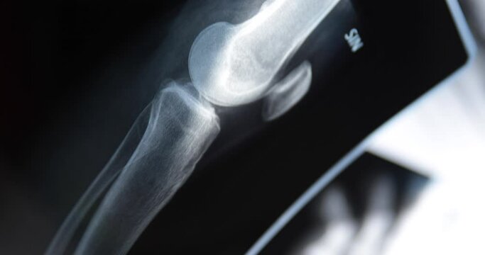 X-ray image of human knee. Problems with bone or joint.