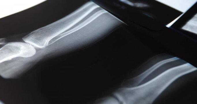 X-ray image of human knee. Problems with bone or joint.