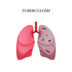 Tuberculosis disease vector, illustration design for medical

