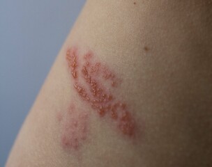 Półpasiec, Shingles, choroby skóry, ospa wietrzna, choroba zakaźna, 
