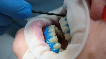 liquid cofferdam to isolate the gums from action of a bleaching agent optragat rotary spreader close-up of the patient's teeth in the process of whitening in the dental clinic blue gloves