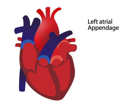 Left atrial appendage (LAA) illustration. Illustration of the LAA open