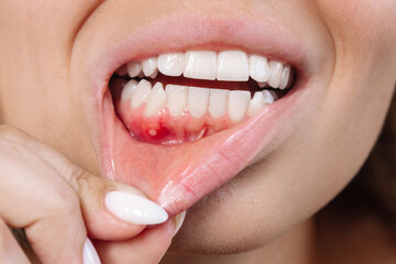 Close up of a ulcerative stomatitis on the gums. Gum inflammation. Cropped shot of a young woman...