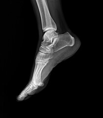 X-ray of a person's ankle and foot