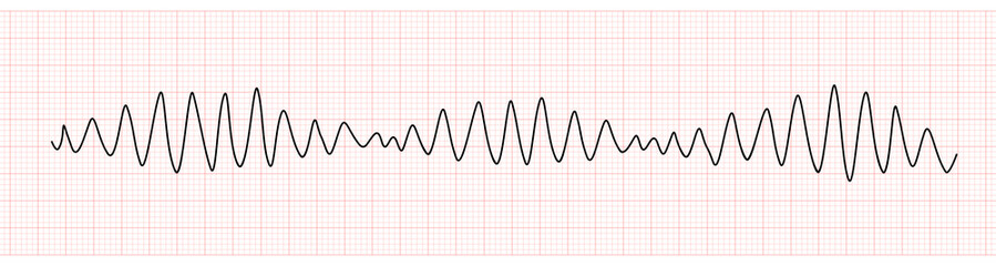 EKG Monitor Showing Polymorphic Ventricular tachycardia or VT: Torsades de pointes