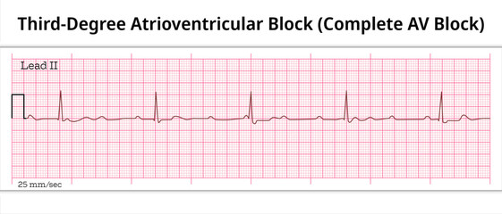 ECG Third Degree Atrioventricular Block - Complete AV Block - 8 Second ECG Paper - Electrocardiography Vector Medical Illustration