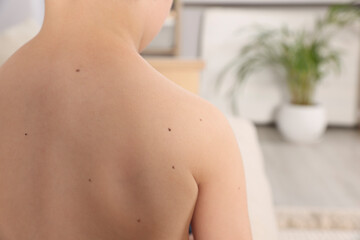 Closeup of boy's body with birthmarks in living room, back view. Space for text