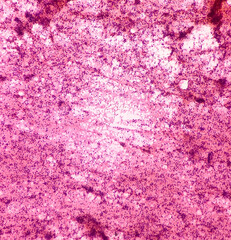 Gluteal region Tumor Cytology. Myeloid sarcoma. Chronic myeloid leukemia. Smear show cellular material composed of immature mononuclear cells admixed with polymorphs, lymphocytes and histiocytes.