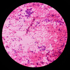 Gluteal region Tumor Cytology. Myeloid sarcoma. Chronic myeloid leukemia. Smear show cellular material composed of immature mononuclear cells admixed with polymorphs, lymphocytes and histiocytes.