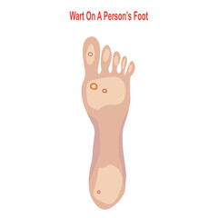 Wart on a persons foot, hard, grainy growth on heels or balls of foot, plantar wart, vector illustration,callus