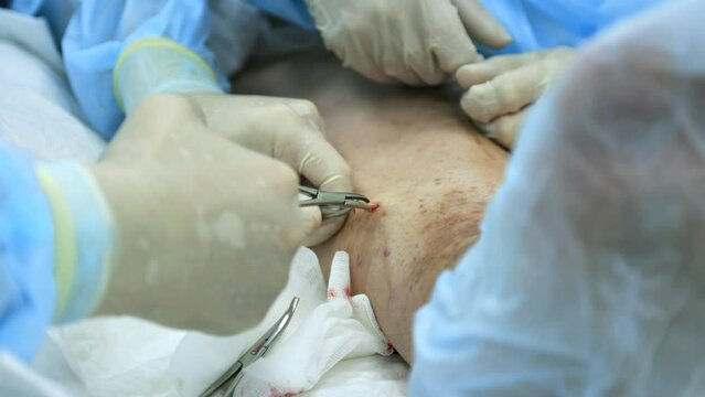 Surgeon pulls out the varicose node on the patient's leg with medical instruments, wiping the protruding blood on a gauze napkin. Process of removing the varicose node during surgery on the leg
