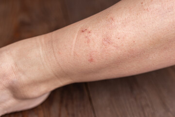 Dry human skin of a woman leg. Concept of skin rehydration cosmetics to keep the skin young. Skin diseases
