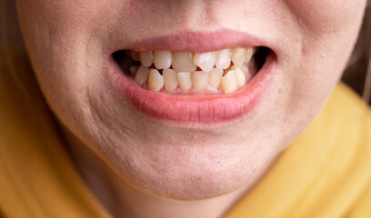 Curved female teeth, before installing braces. Close - up of teeth before treatment by an...