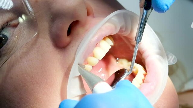 close-up woman dentistry brushing teeth cleaning removing plaque stones saliva ejector using oral mirrors newest technology sandblaster goggles water drops spilling to sides optragate mouth expander