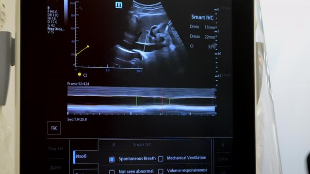 Utrasound image on the monitor close-up. Ultrasound Scan display. Ultrasound Scan Device. Echocardiography. Screening Ultrasonography Analysis of person. Ultrasound examination. Using Scanner.