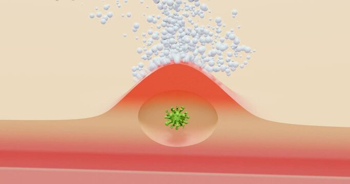 Viral subcutaneous inflammation, herpes - 3d animation showing symbolic dermatitis with a virus, and treatment with a cream.