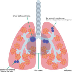 肺がんの腫瘍ができる場所を示したイラスト／Illustration showing where lung cancer tumors form