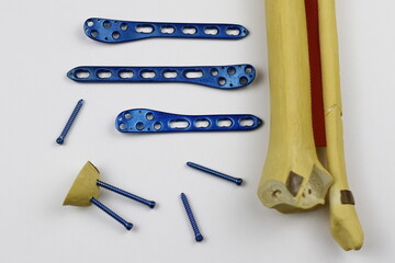 Surgical plates for osteosynthesis in case of bone fractures	