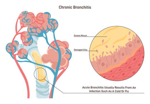 Chronic bronchitis. Pulmonary disease with airways mucus obstruction.