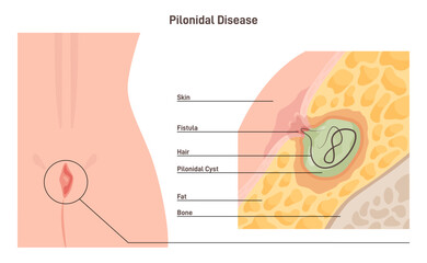 Pilonidal disease. Skin infection or cyst with ingrown hair between - obrazy, fototapety, plakaty