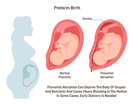 Preterm birth. Placental abrupted and early baby delivery. Pregnancy