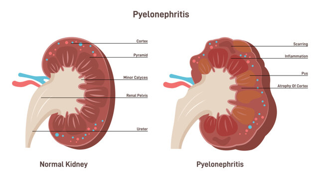 Pyelonephritis. Kidney infection disease, inflammation of organ tissue