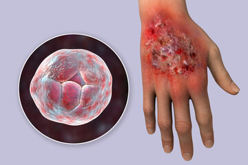 Protothecosis infection on human hand and close-up view of Prototheca wickerhamii green algae, 3D illustration - obrazy, fototapety, plakaty