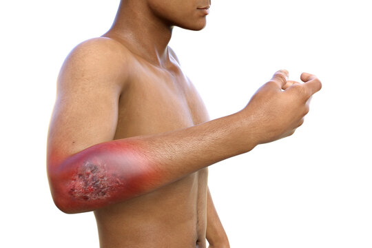 Protothecosis infection on human arm, 3D illustration