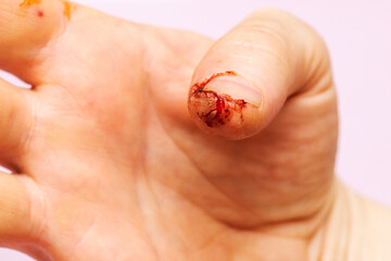 Physical injury of hand finger. Fresh wound with blood on male finger