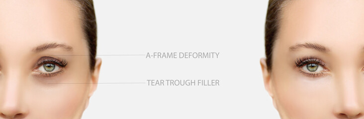  Tear Trough Filler,A-frame deformity. Fat grafting or dermal filler treatments .Hyaluronic acid...