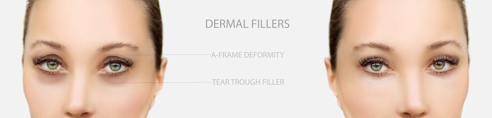  Tear Trough Filler,A-frame deformity. Fat grafting or dermal filler treatments .Hyaluronic acid injections for specific areas.