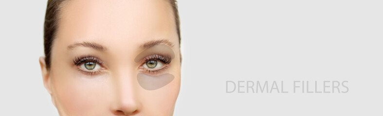  Tear Trough Filler,A-frame deformity. Fat grafting or dermal filler treatments .Hyaluronic acid...