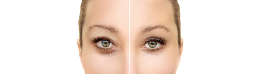 Fototapeta premium Lower and upper Blepharoplasty.Marking the face.Perforation lines on females face, plastic surgery concept.