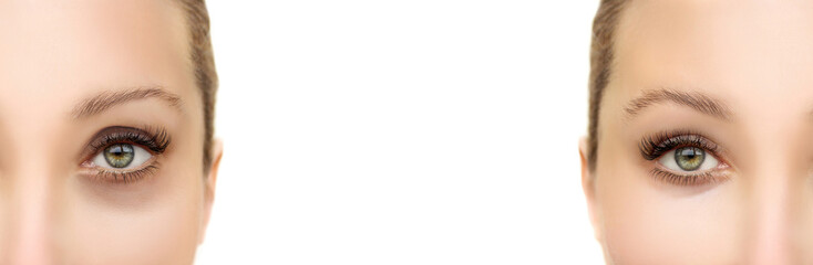  Tear Trough Filler,A-frame deformity. Fat grafting or dermal filler treatments .Hyaluronic acid injections for specific areas.