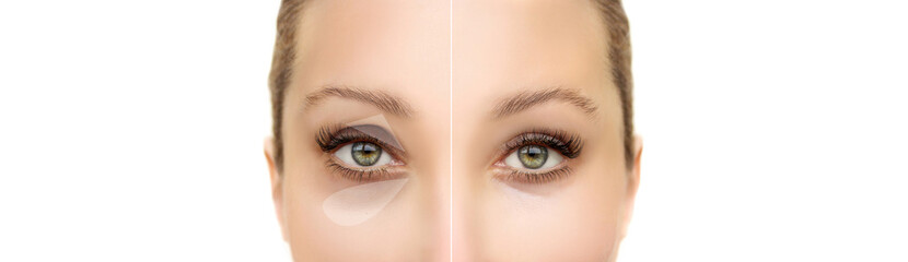 Fototapeta premium Tear Trough Filler,A-frame deformity. Fat grafting or dermal filler treatments .Hyaluronic acid injections for specific areas.