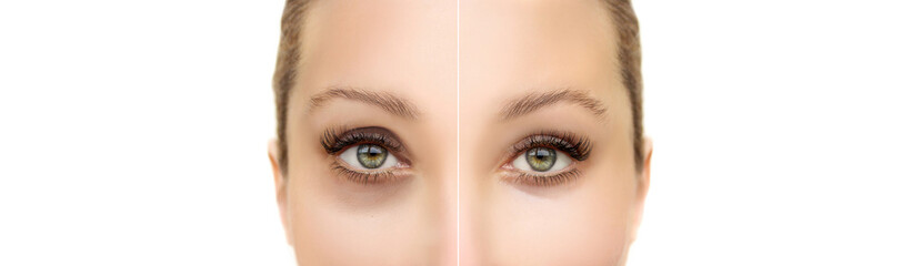 Fototapeta premium Tear Trough Filler,A-frame deformity. Fat grafting or dermal filler treatments .Hyaluronic acid injections for specific areas.